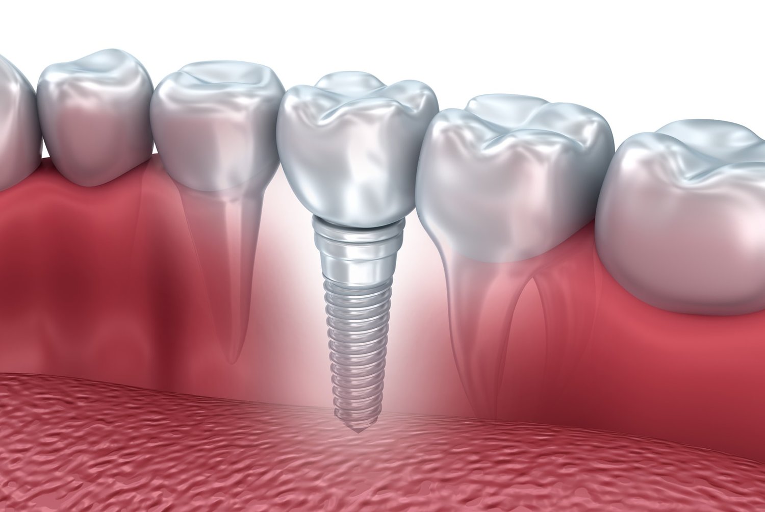 Dental Implants in Pointe-Claire